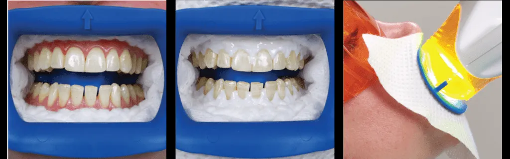 30645 whitening cost