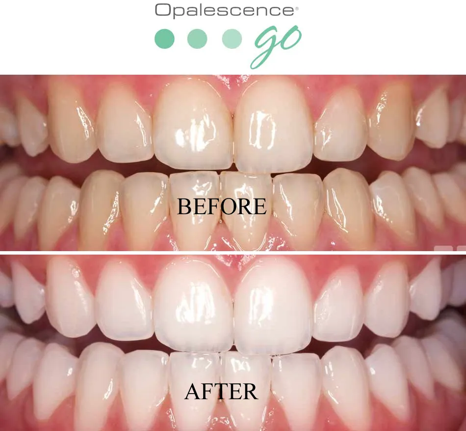 30645 zoom whitening process