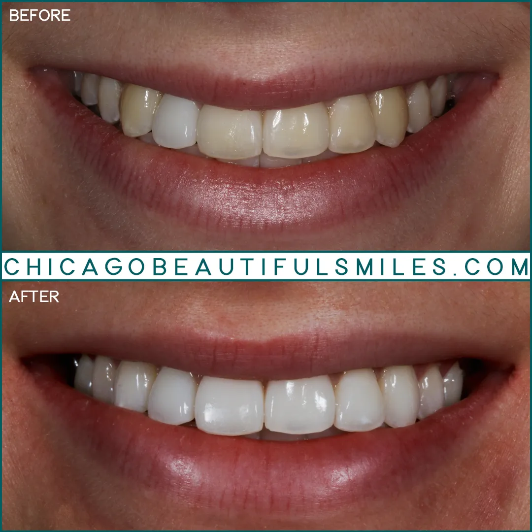 30647 at home whitening kits