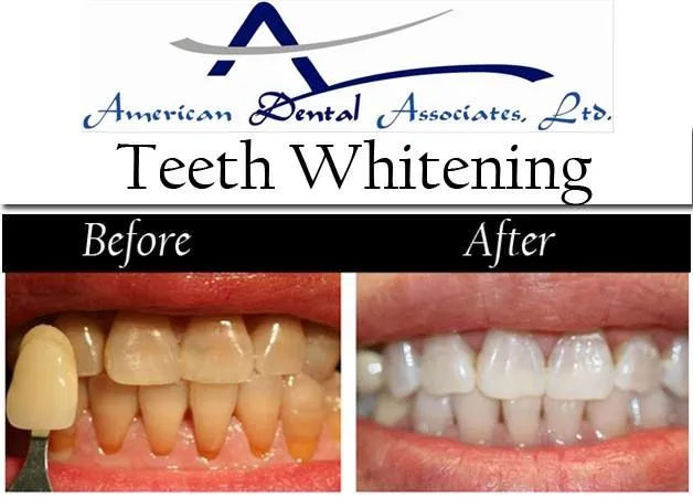 30647 in office whitening