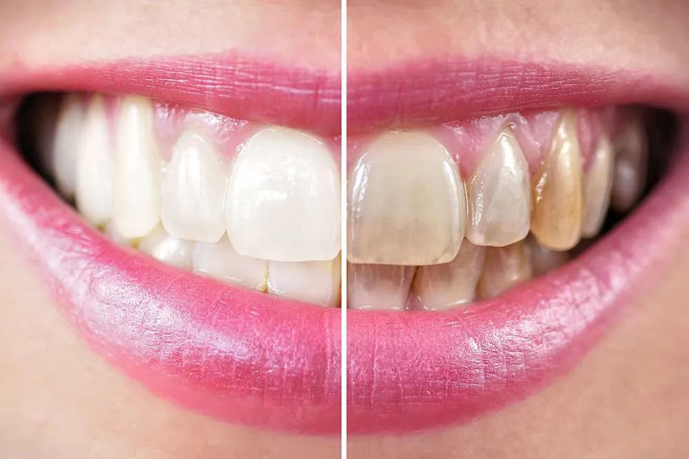 30648 teeth whitening cost