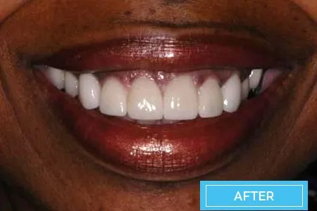 /img/30649-maintaining-teeth-whitening-results.webp