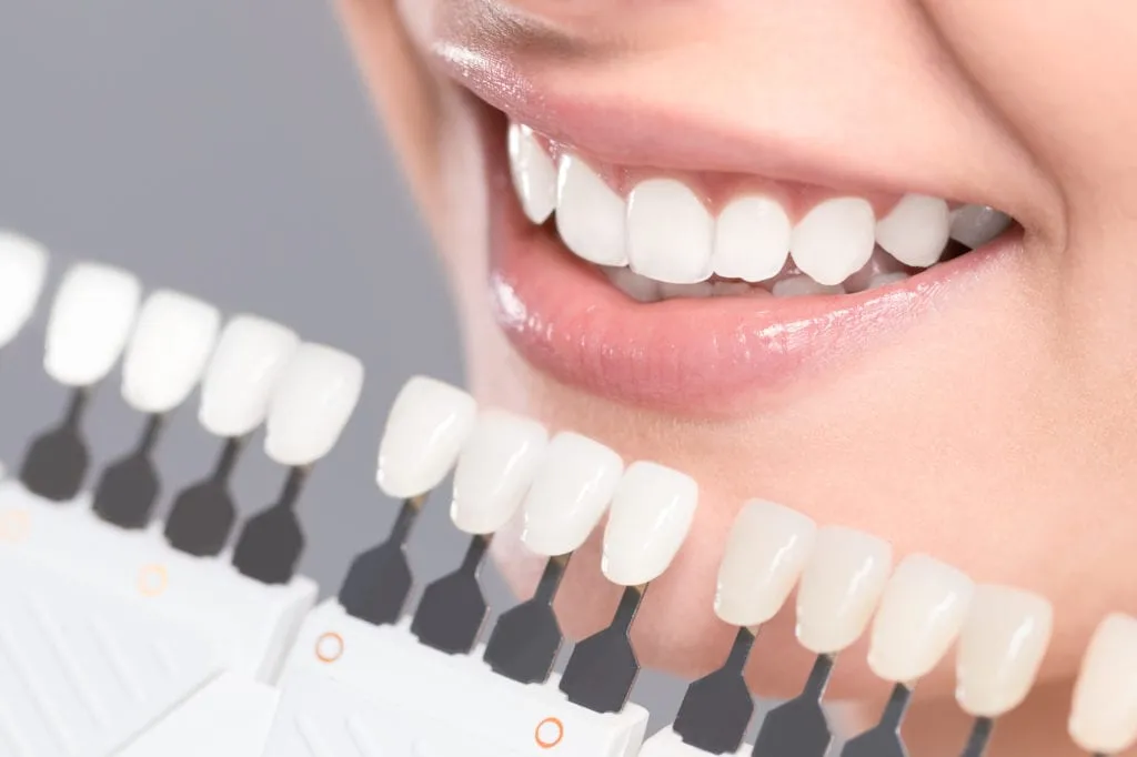 30649 professional teeth whitening corona ca