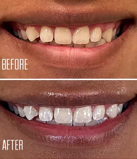 30649 teeth whitening expectations