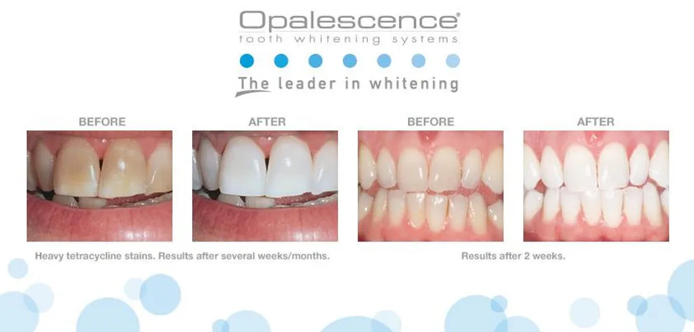 /img/30650-teeth-whitening-results.webp