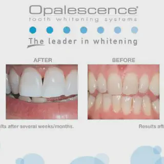 /img/30650-teeth-whitening-results.webp