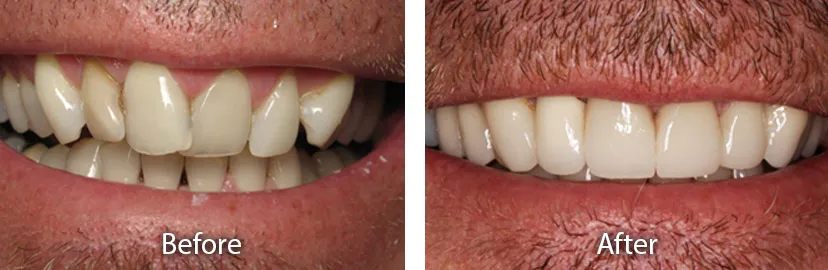 30651 at home teeth whitening tempe