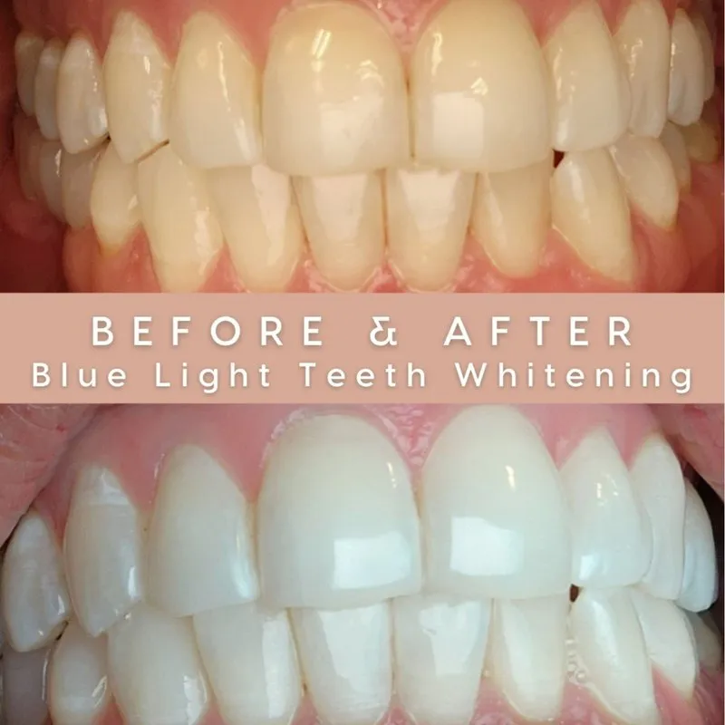 30651 in office teeth whitening tempe