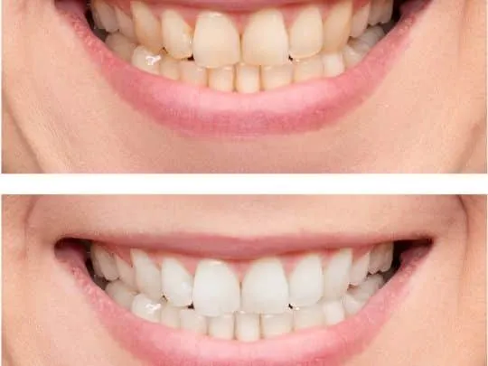 30651 teeth whitening tempe before after