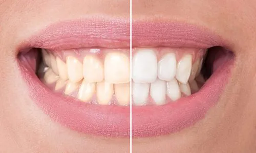 30651 teeth whitening tempe consultation