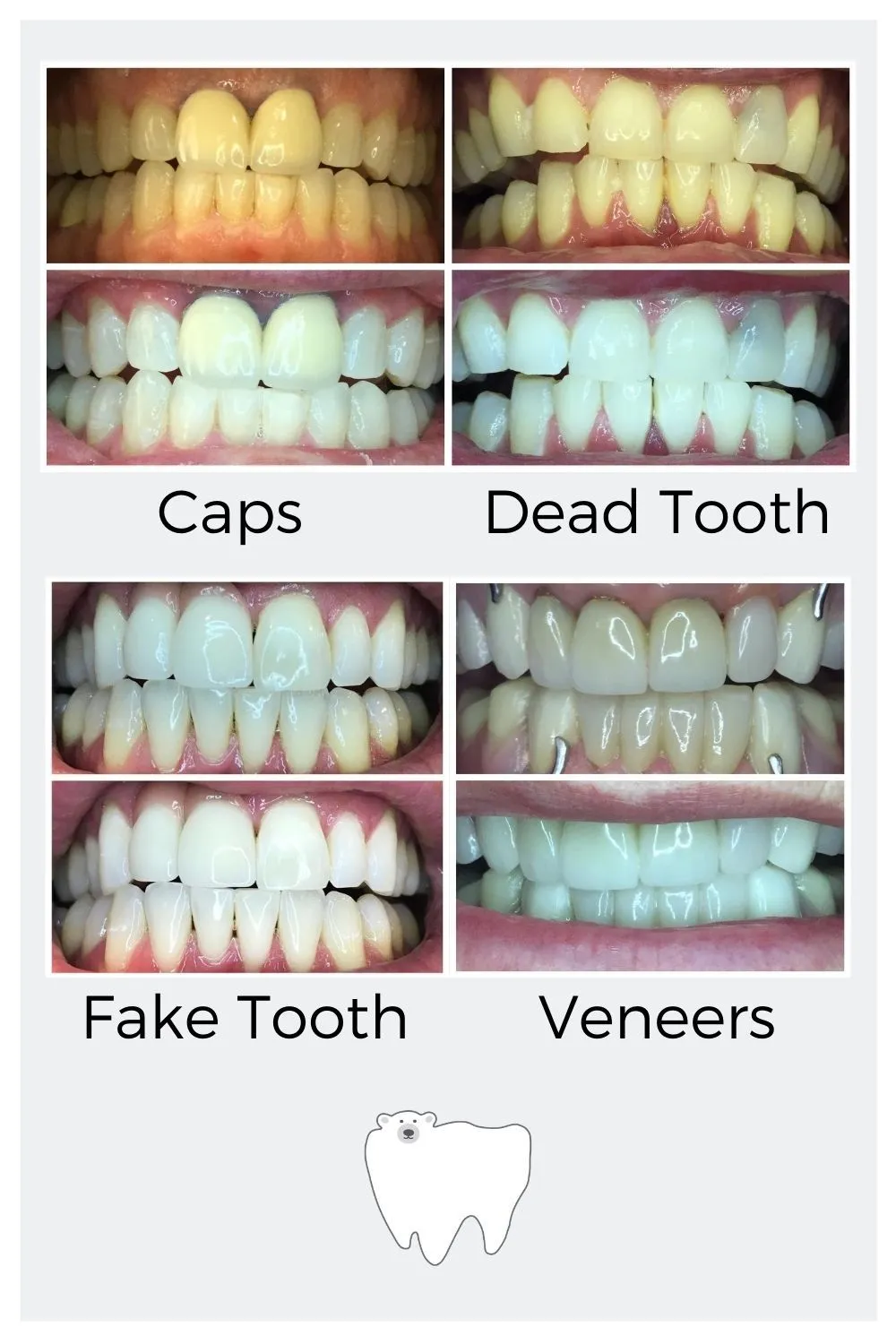 30653 at home teeth whitening