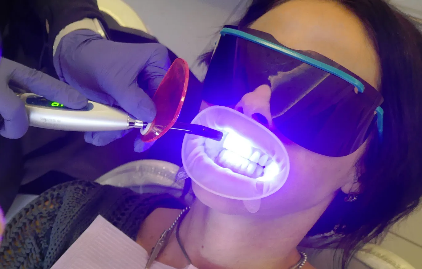 30653 laser teeth whitening
